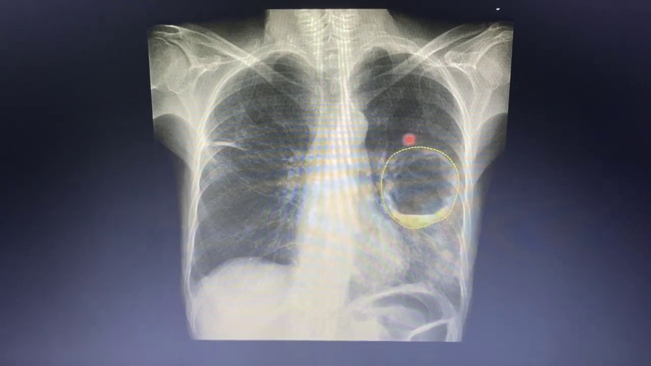 Achados da tuberculose no Rx de tórax  | RX COMENTADO