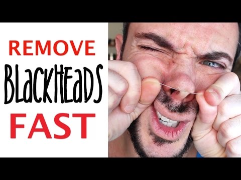 GET RID of BLACKHEADS FAST...w/ DENTAL FLOSS? | Does It Really Work? | Cheap Tip #256 Video