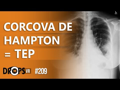 CORCOVA DE HAMPTON - VOCÊ SABE IDENTIFICAR ESSE SINAL NA RADIOGRAFIA DE TÓRAX?