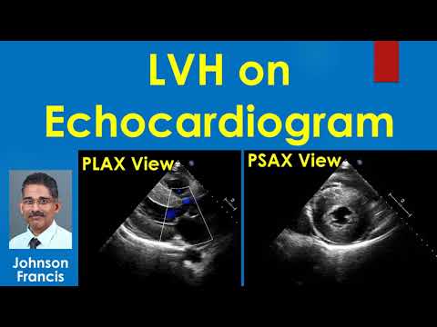 LVH on Echocardiogram