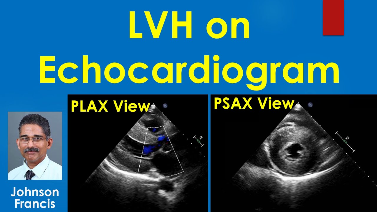 LVH on Echocardiogram