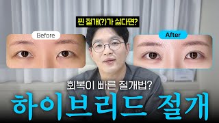 절개도 아니고 비절개도 아닌 하이브리드 절개란 게 뭐예요?🤷‍♀️ | 하이브리드 절개