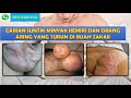 Cara Menghilangkan Bekas Suntik Minyak Kemiri Pada Kemaluan Pria
