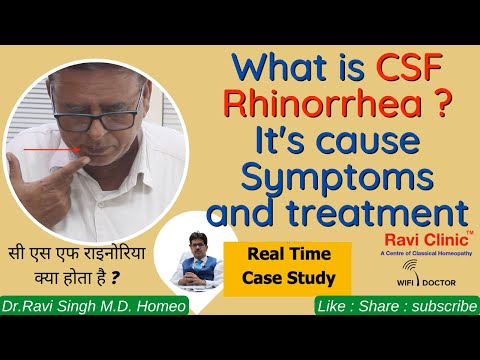 Case of CSF rhinorrhea From Churu, Rajasthan Cured