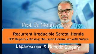 Miniaturka - Recurrent Irreducible scrotal Hernia. TEP Repair. Metin Ertem MD.FACS