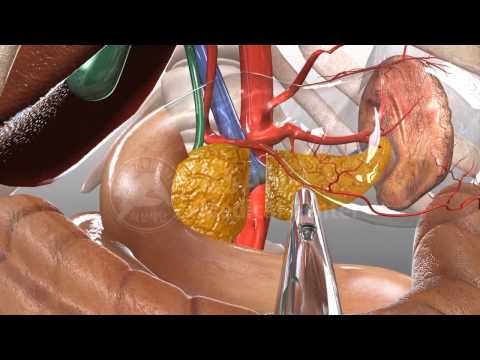 Pancreatic tail resection