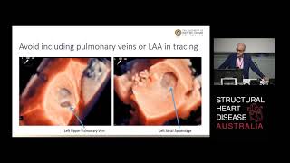 Measuring Left Atrial Volume is Important in Predicting Outcome – Prof David Playford