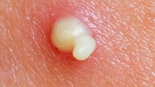 🔍 Pimple Popping Masterclass: Safe Acne Removal & Scar Prevention | 2024 Update | TheCoolFactShow