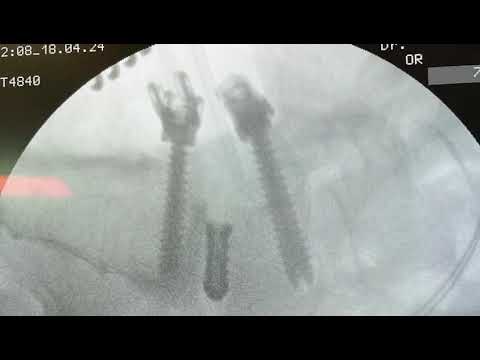 NeuroPal spinal team