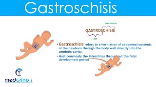 Gastroschisis: Definition, Causes and Diferences with Omphalocele