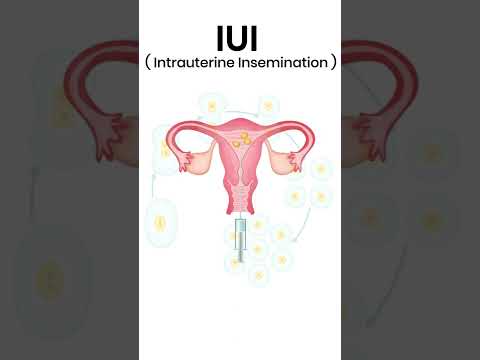 IUI Process |  Pravi Test Tube Baby Centre Kanpur