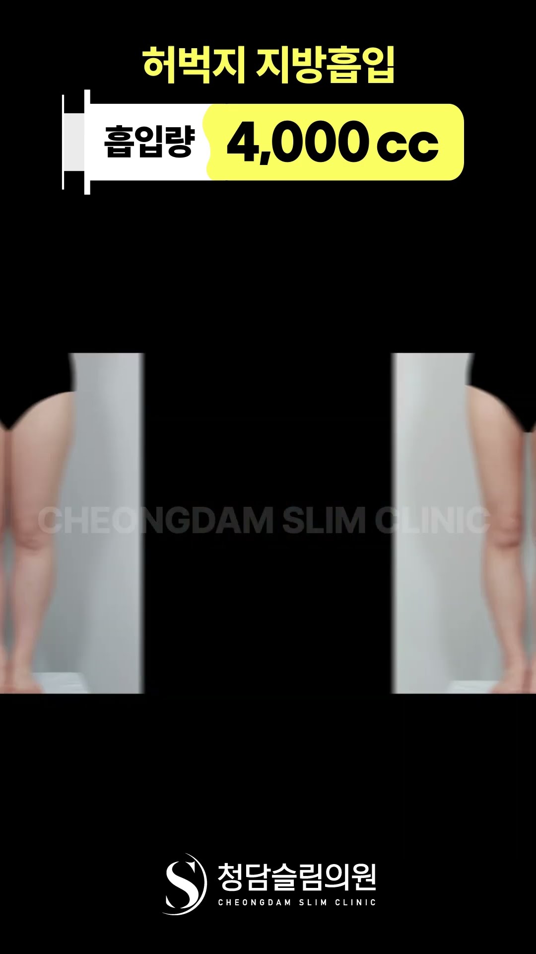 원래 얇았던 것 처럼 허벅지 지흡 전…