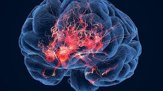 Hope for Treating Huntington’s Disease