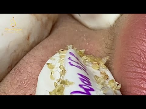 Loan Nguyen Acne Treatment (#109)