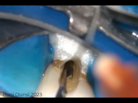 A guided approach to broken instrument retrieval using the BTR pen