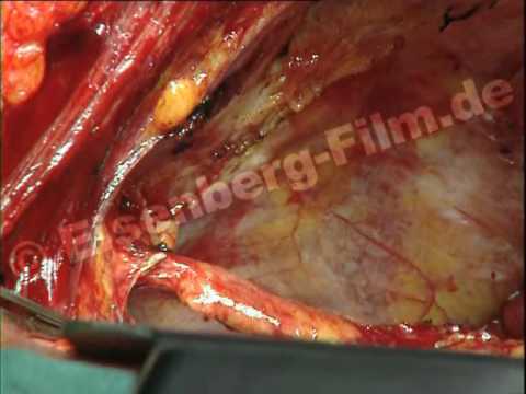 Lehrvideo: Bypass mit arteriellen Grafts am offenen Herz