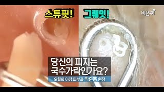 [기획취재] 당신의 피지는 국수가락인가요?