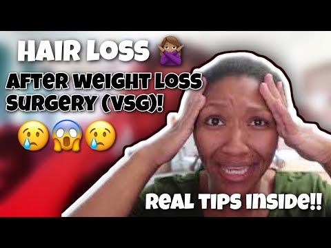 VSG Journey | Hair Loss after VSG | Tips