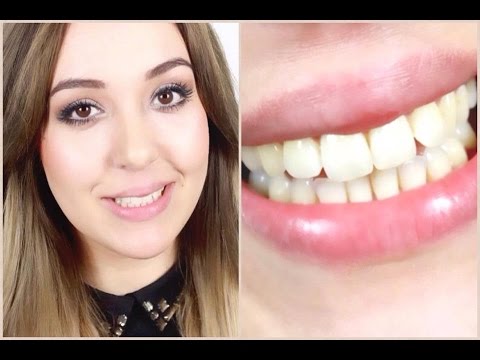 WEISSE ZÄHNE  | WHITENING LIGHTNING |  VERLOSUNG | DIAL A SMILE | LIVE TEST