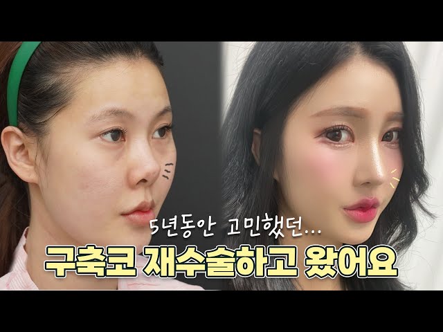 더하다성형외과 :: 구축코 재건술, 고난이도 코재수술_더하다 TV_코재수술 더하다성형외과 :: 구축코 재건술, 고난이도 코재수술_더하다 Tv_코재수술
