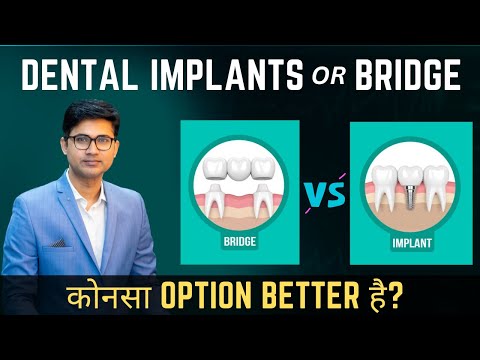 Dental Implant vs Bridge | In Hindi | Missing Teeth के लिए क्या बेहतर है?