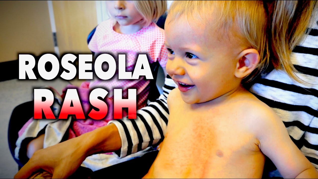 Classic ROSEOLA RASH (Cutest Kid EVER) | Dr. Paul
