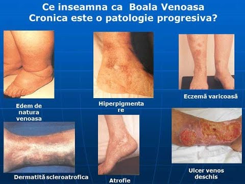 tatal tsarist din varicoza cumpara