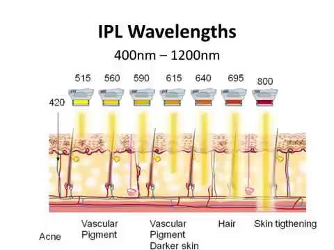 download lagu mp3 mp4 Ipl Hair Removal Vs Laser, download lagu Ipl Hair Removal Vs Laser gratis, unduh video klip Ipl Hair Removal Vs Laser