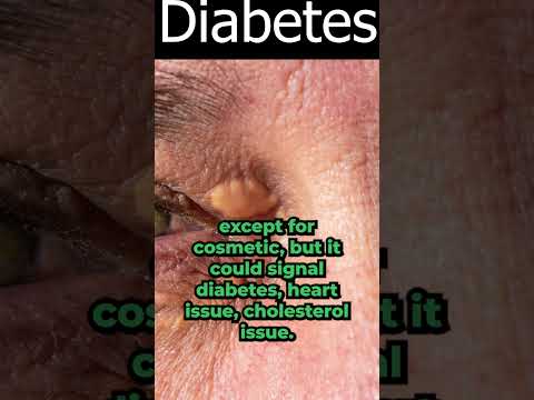 Skin Tag Removal Wart Removal How To Get Rid Of Skin Tags Warts