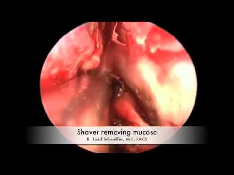 Transnasal Approach for Surgery of the Pituitary Gland