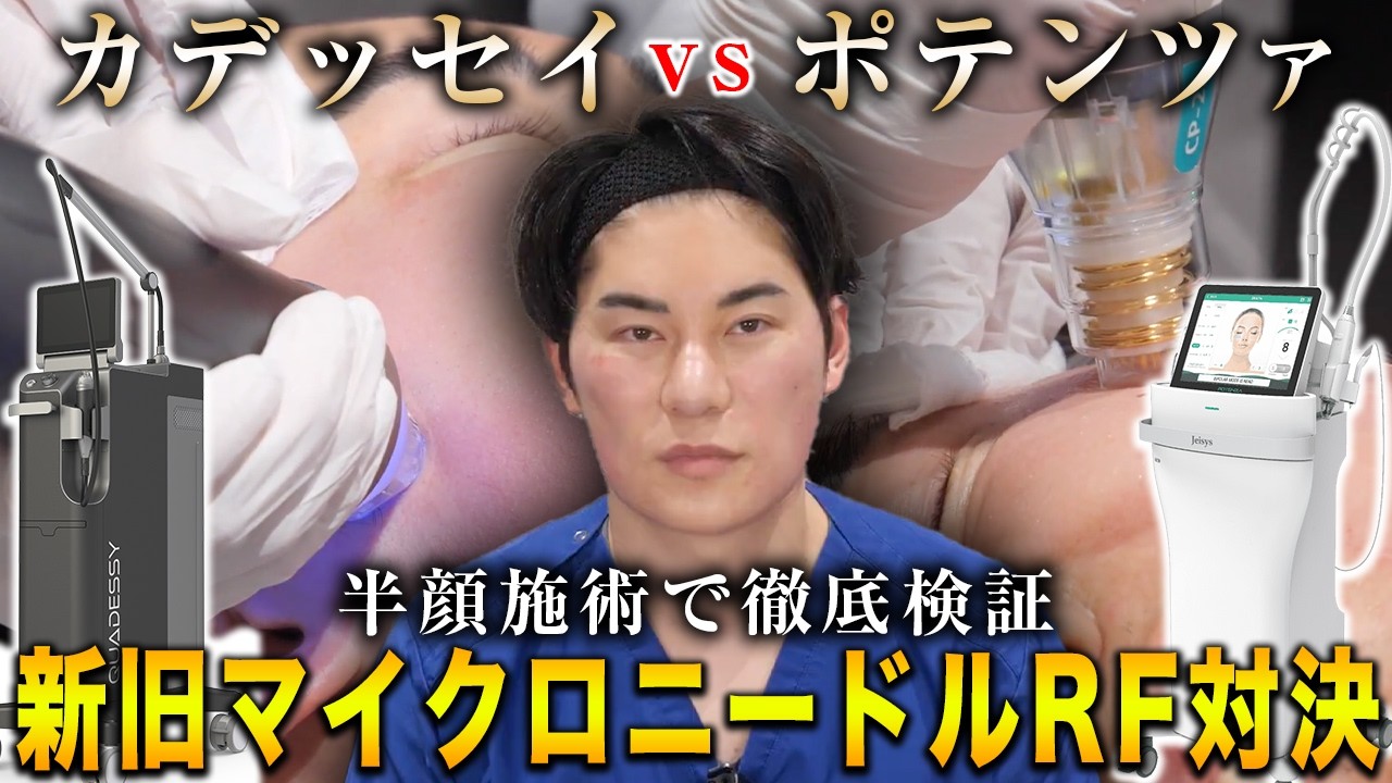 話題のニキビ跡毛穴治療マイクロニードルRF最強決定戦！カデッセイとポテンツァを半顔ずつ受けました。
