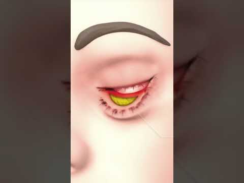 Blepharoplasty Explained | Eyelid Surgery for Youthful Eyes | Doctor ns | Cosmo Radiance Hyderabad