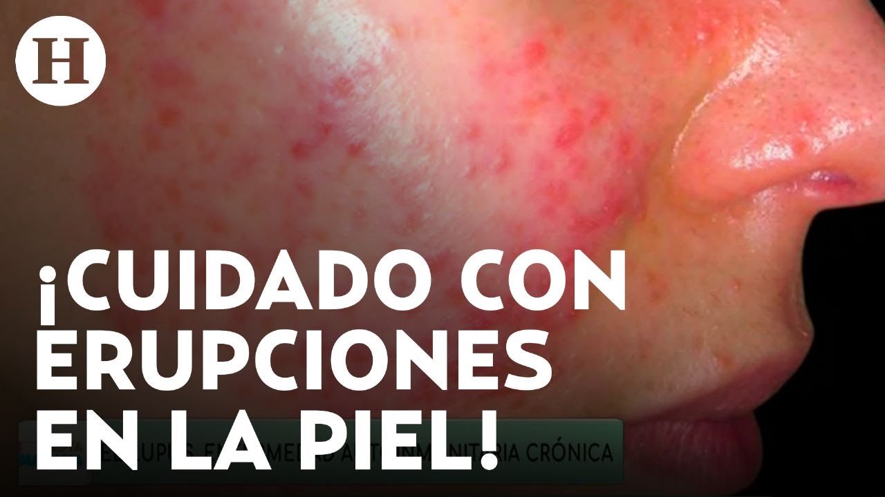 ¿Qué es y cómo detectar el lupus? Tratamiento, diagnóstico y síntomas