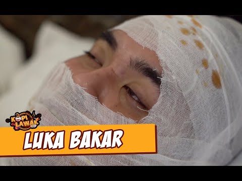 kopi-lawak-luka-bakar