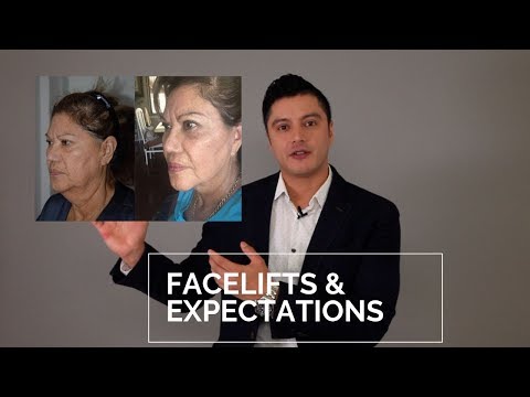 Facelifts & Plastic​ Surgery Expectations | Tony Medina