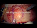 Surgical resection of brain tumor (meningioma).  Complete video presentation.