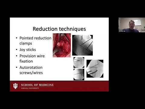 Femoral Neck Fractures - Jang Young, M.D. | HOGR-HUP 2024