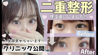 【ガチで整形しました❕】二重埋没法✨ダウンタイム・クリニック・金額大公開( ˘ •ω• ˘ )♡?念願の平行二重に♩?【絆創膏卒業しました❕❕❕❕】