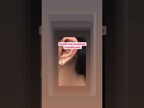 Watch Video: Dr. Rizk shares his patient’s results one week after Rhinoplasty