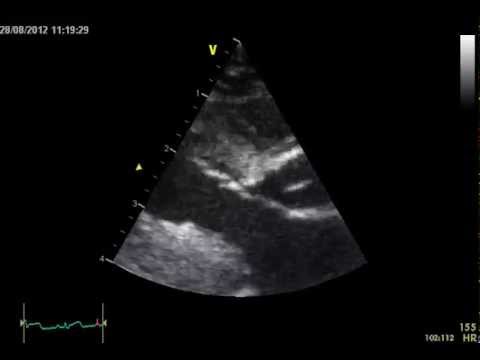 Systolic anterior motion of the mitral valve (SAM) in a cat