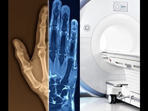 Angina Osteochondrose Milt Bewertungen an den Gelenken