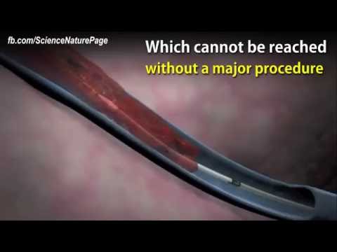 An interesting procedure for the treatment of deep vein thrombosis