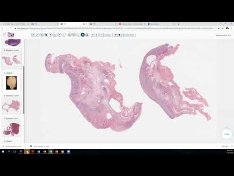 Digital Pathology Sign out 22- Brenner tumor