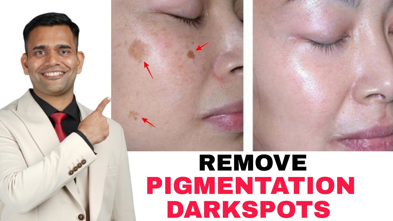Get Rid Of Pigmentation Darkspots Naturally at Home
