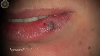 Effective Treatment for Hemangioma on Lower Lip with Laser