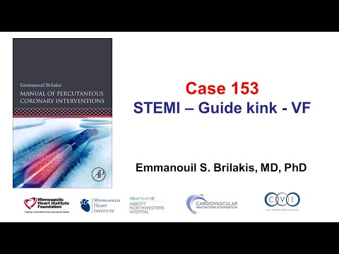 Case 153: PCI Manual - STEMI, kinked guide, VF
