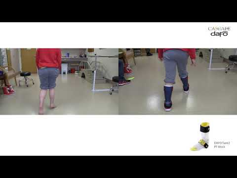 Before and After | Strong toe walking | DAFO Tami2