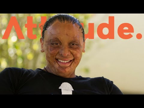 Burns Survivor's Story: Maia’s Story