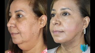 Transformed by Local Anesthesia Face Lift: Patient Testimonial