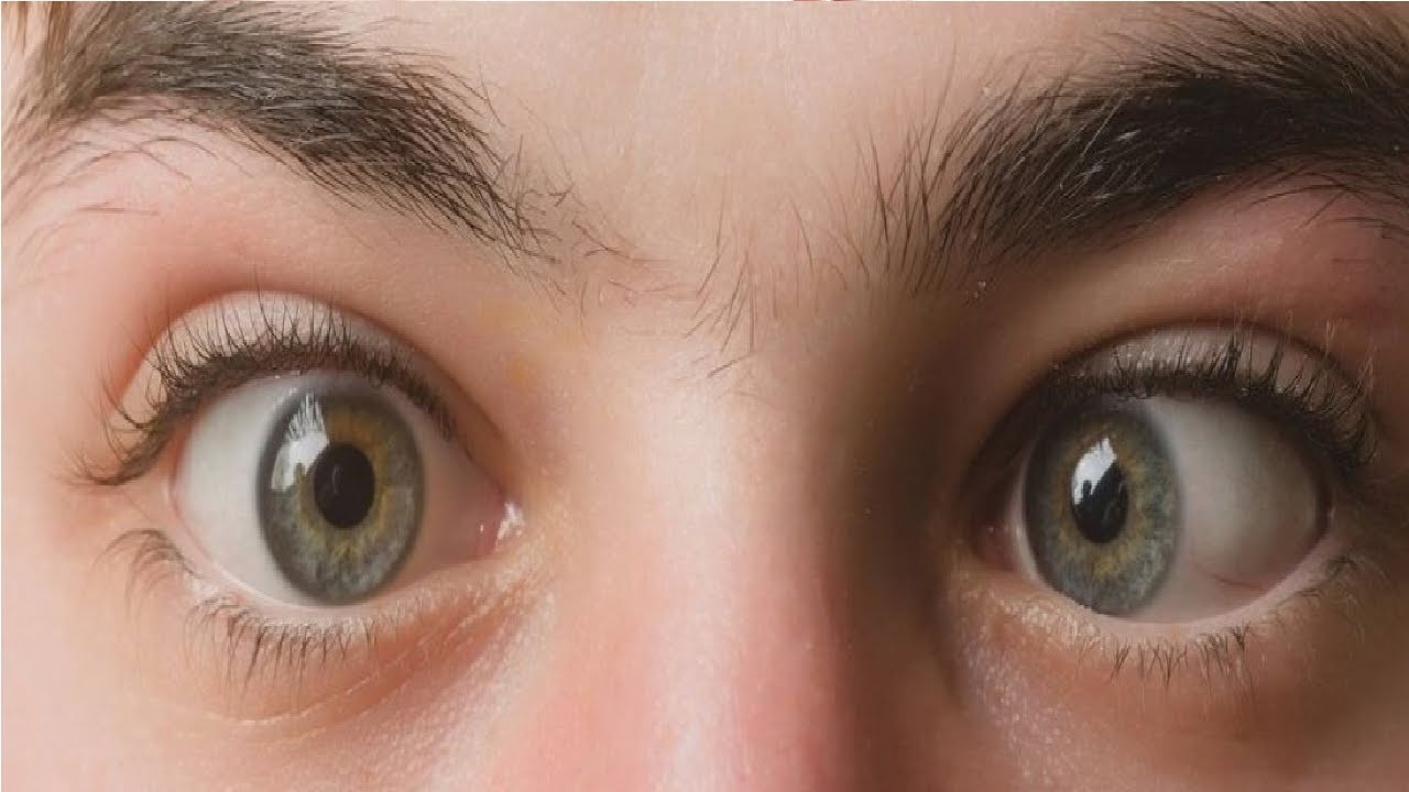 how to get rid of a lazy eye in pictures